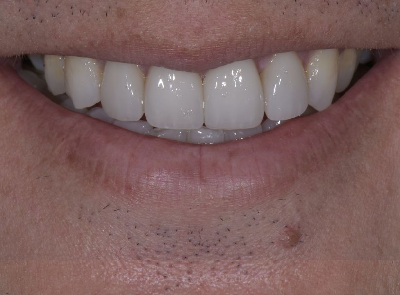 combined veneer composite smile after