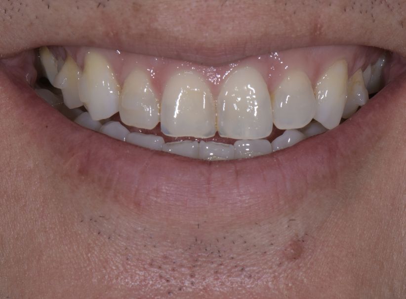 combined veneer composite smile before