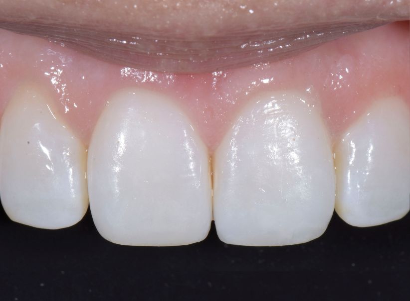 composite artistry front tooth restoration after