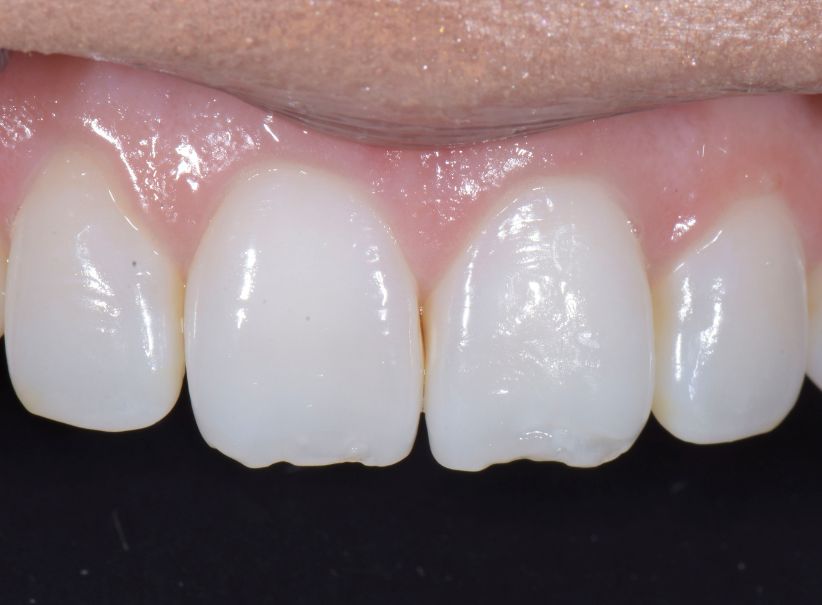 composite artistry front tooth restoration before