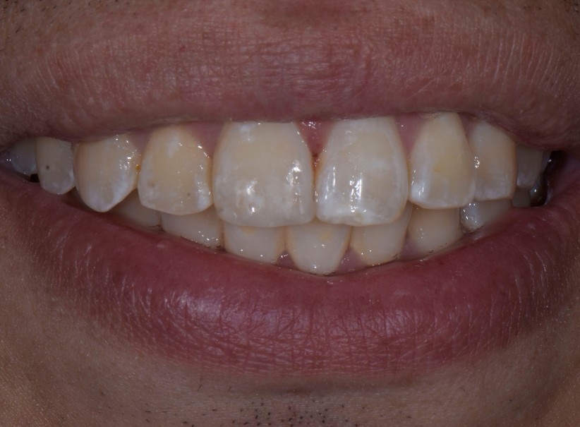 composite artistry front tooth restoration luminous smiles after