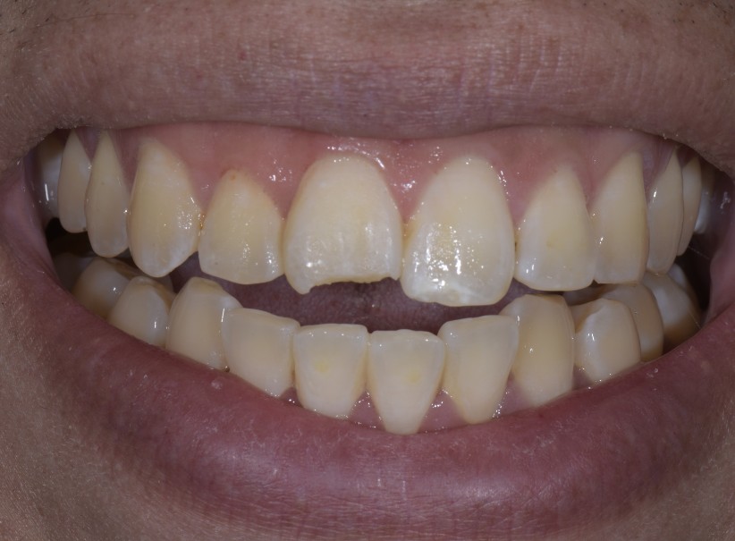 composite artistry front tooth restoration luminous smiles before composite artistry front tooth restoration luminous smiles before