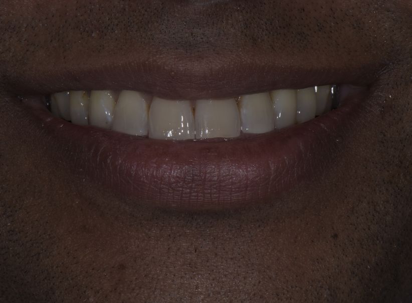 composite bonding front tooth repair after