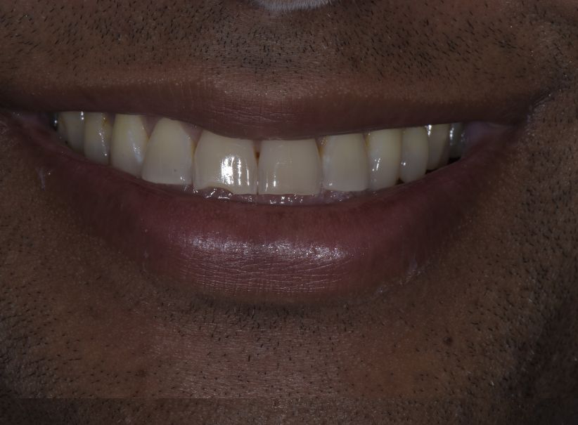 composite bonding front tooth repair before composite bonding front tooth repair before