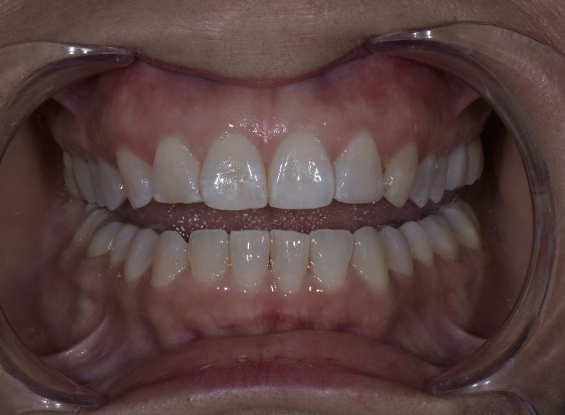 composite lateral incisor repair after