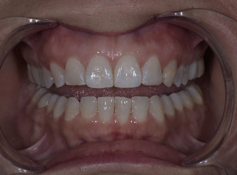 composite lateral incisor repair before composite lateral incisor repair before