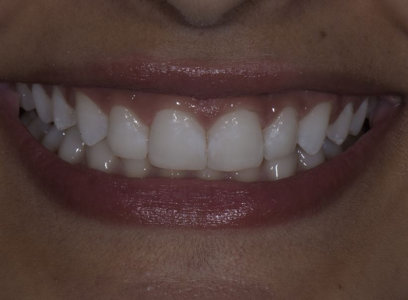 composite veneer smile correction after