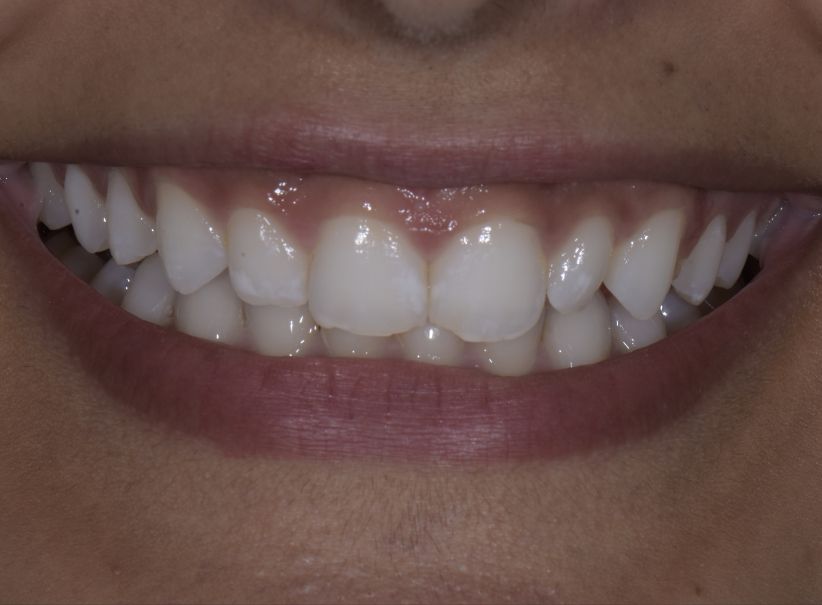 composite veneer smile correction before composite veneer smile correction before