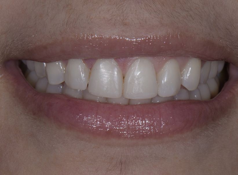 composite veneer smile restoration after