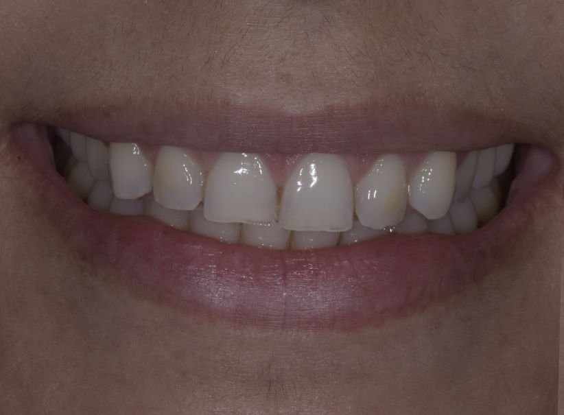 composite veneer smile restoration before