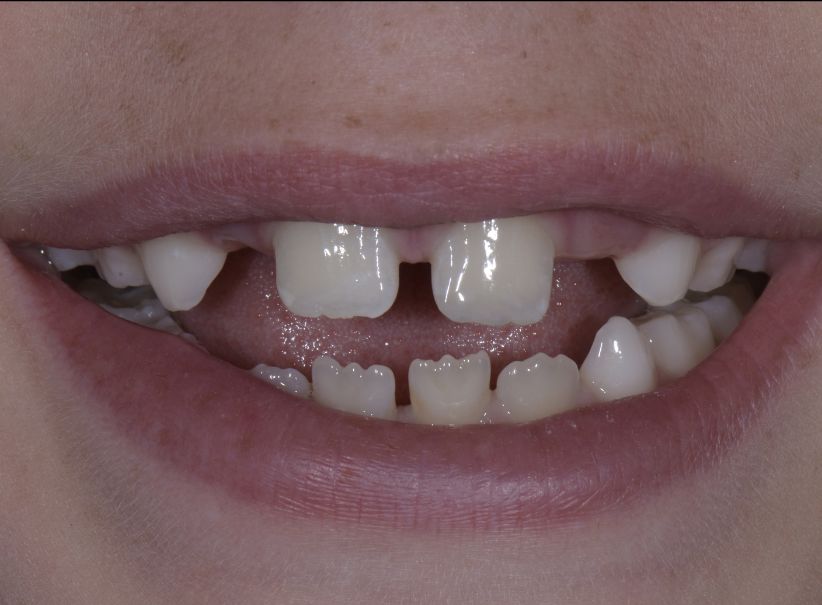 conservative composite tooth repair after