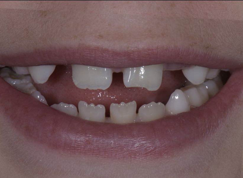 conservative composite tooth repair before conservative composite tooth repair before