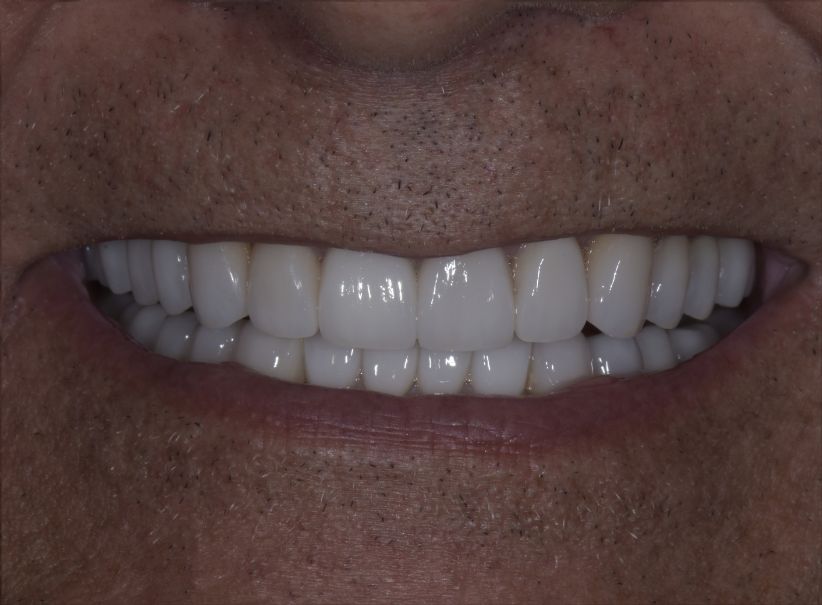 deep bite full mouth rehabilitation after