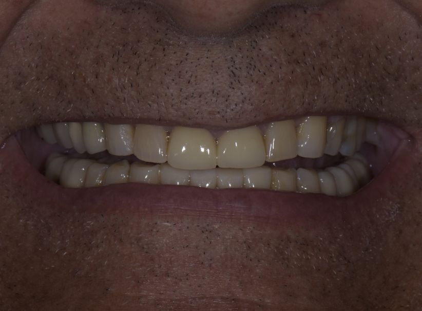 deep bite full mouth rehabilitation before deep bite full mouth rehabilitation before