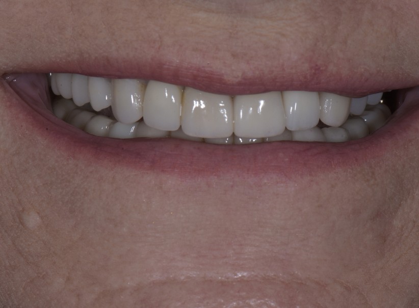 dental implant crown tooth replacement after