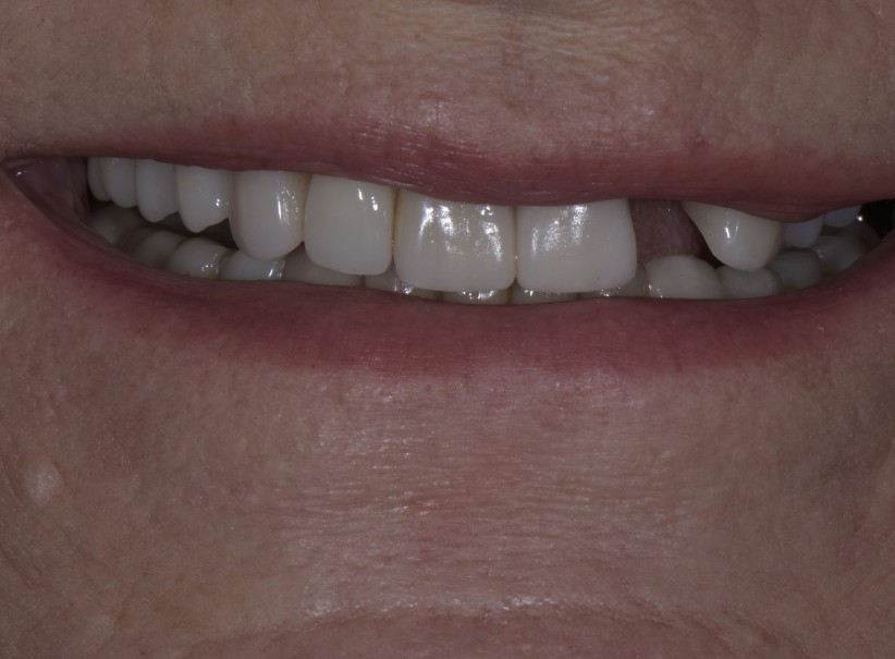 dental implant crown tooth replacement before dental implant crown tooth replacement before