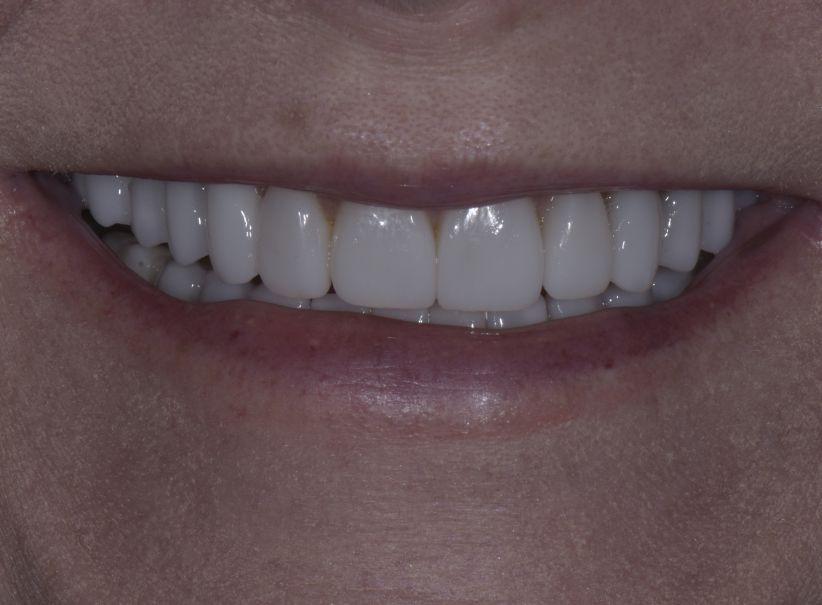 full mouth rehabilitation smile rebuild after