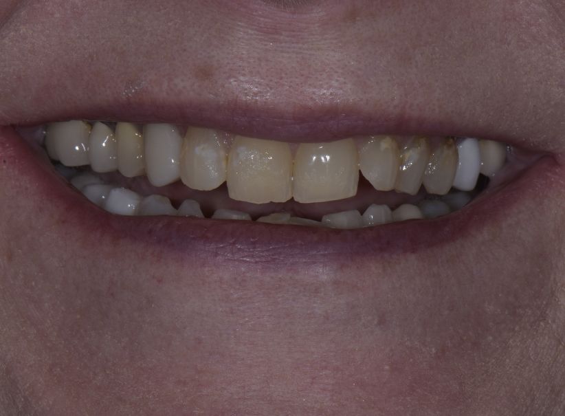 full mouth rehabilitation smile rebuild before