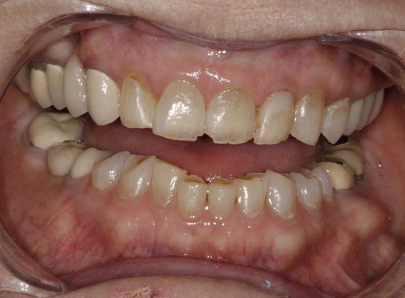 full mouth rehabilitation worn teeth before