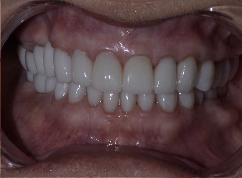 full mouth rehabilitation worn teeth=after
