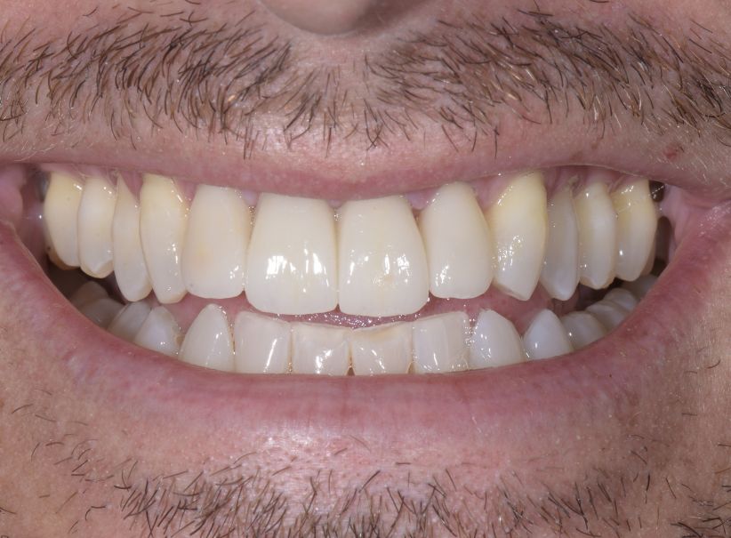 implant veneer smile restoration after