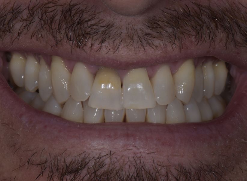 implant veneer smile restoration before implant veneer smile restoration before