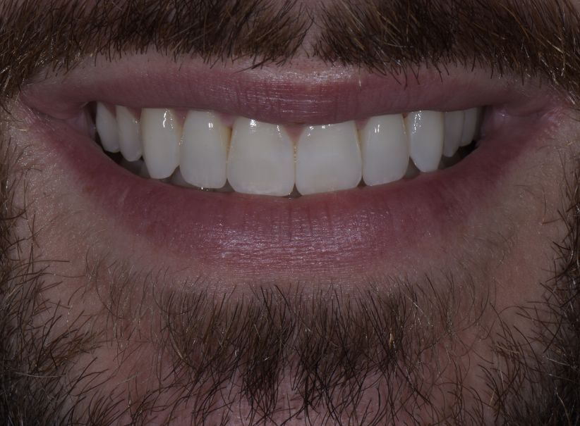 lateral incisor veneer smile enhancement after