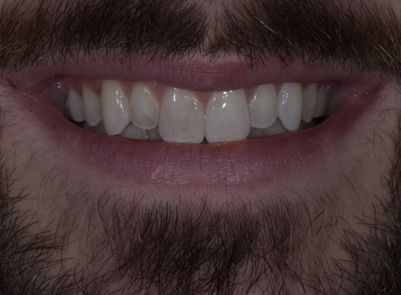 lateral incisor veneer smile enhancement before lateral incisor veneer smile enhancement before