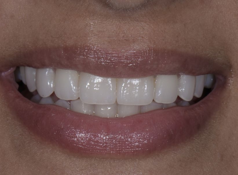 prep less veneer smile enhancement after