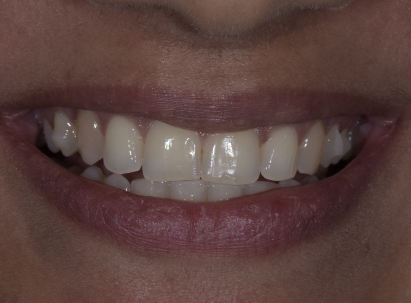 prep less veneer smile enhancement before