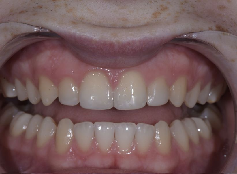 rejuvenated smile full arch treatment after