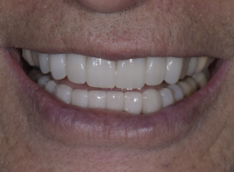 rejuvenated smile full arch treatment after