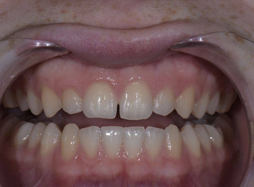rejuvenated smile full arch treatment before