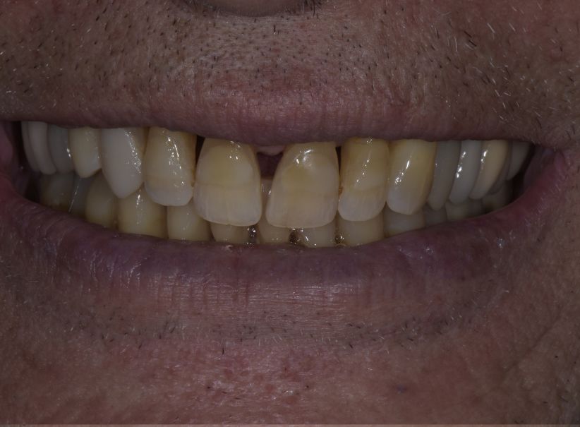 rejuvenated smile full arch treatment before rejuvenated smile full arch treatment before