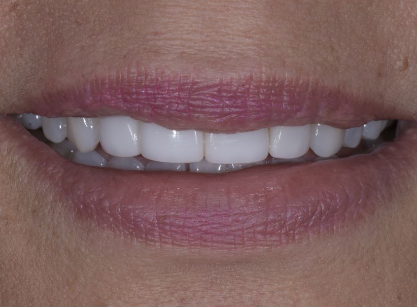 ten veneer smile transformation after
