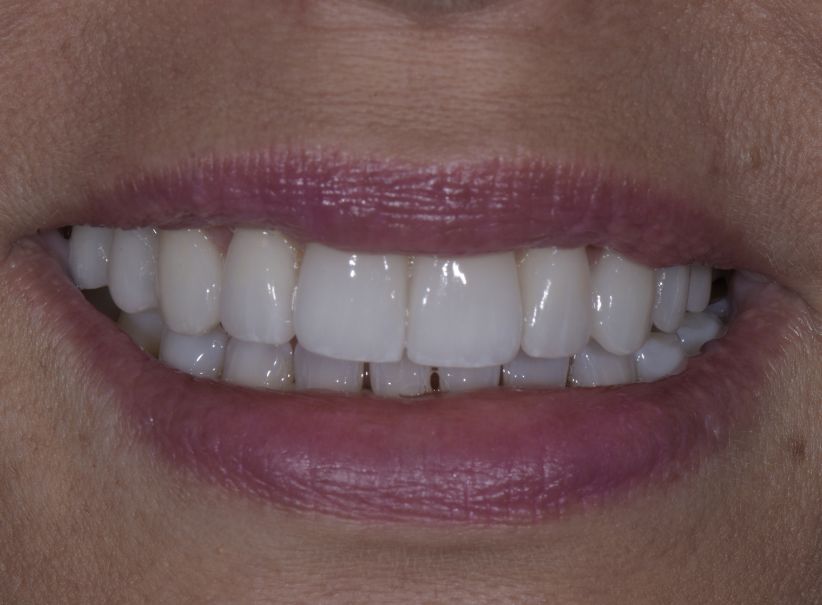 ten veneer smile transformation before ten veneer smile transformation before