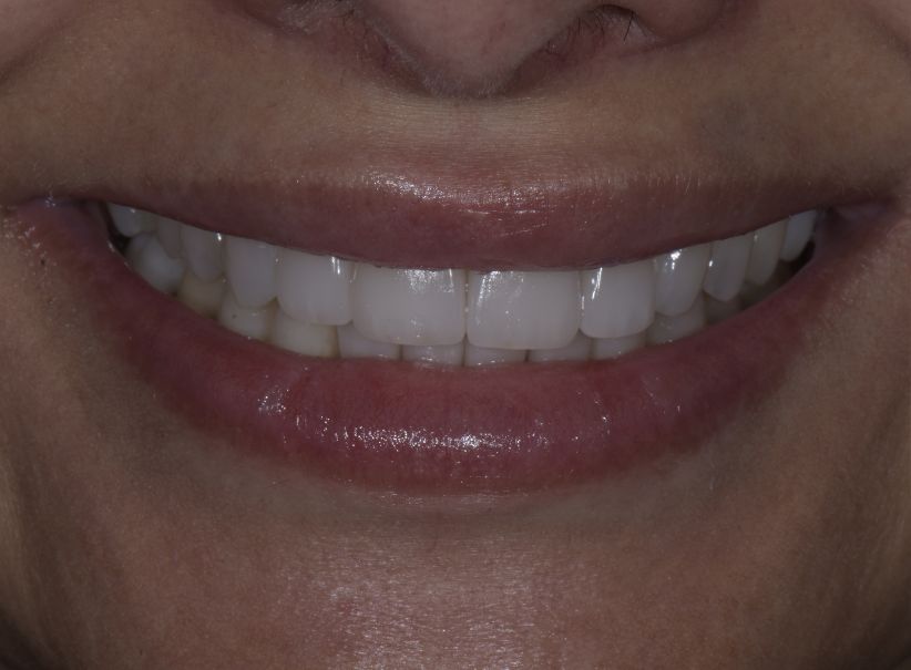 upper lower veneer smile balance after