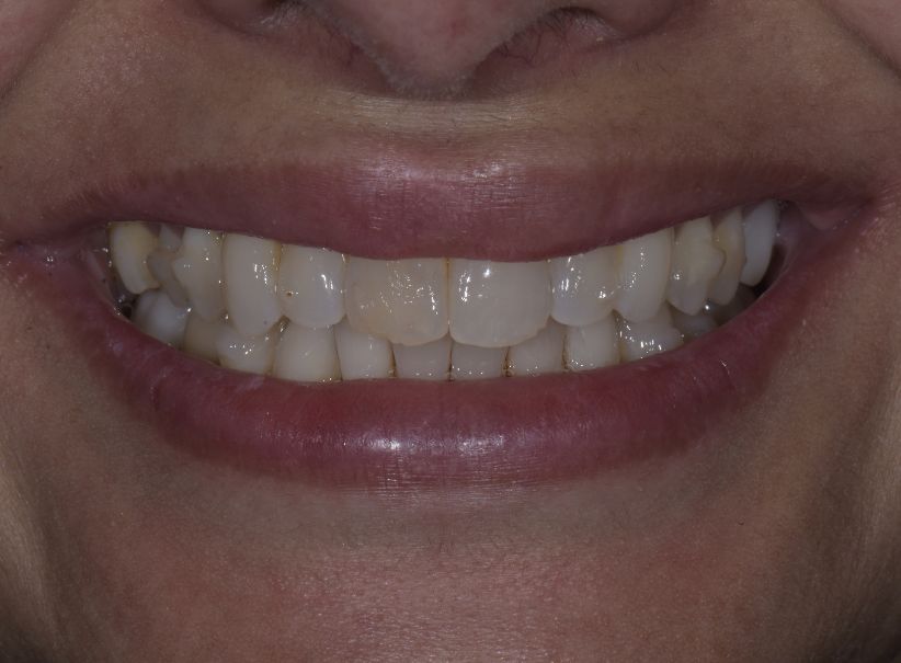 upper lower veneer smile balance before upper lower veneer smile balance before