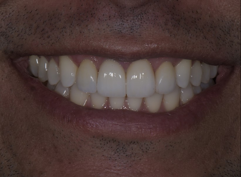 veneer replacement smile enhancement luminous smiles after