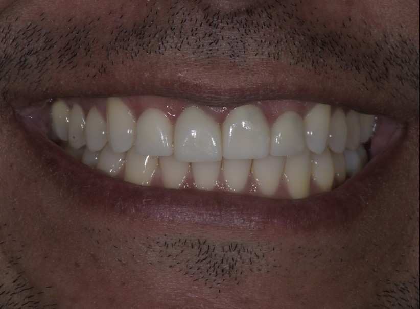 veneer replacement smile enhancement luminous smiles before veneer replacement smile enhancement luminous smiles before