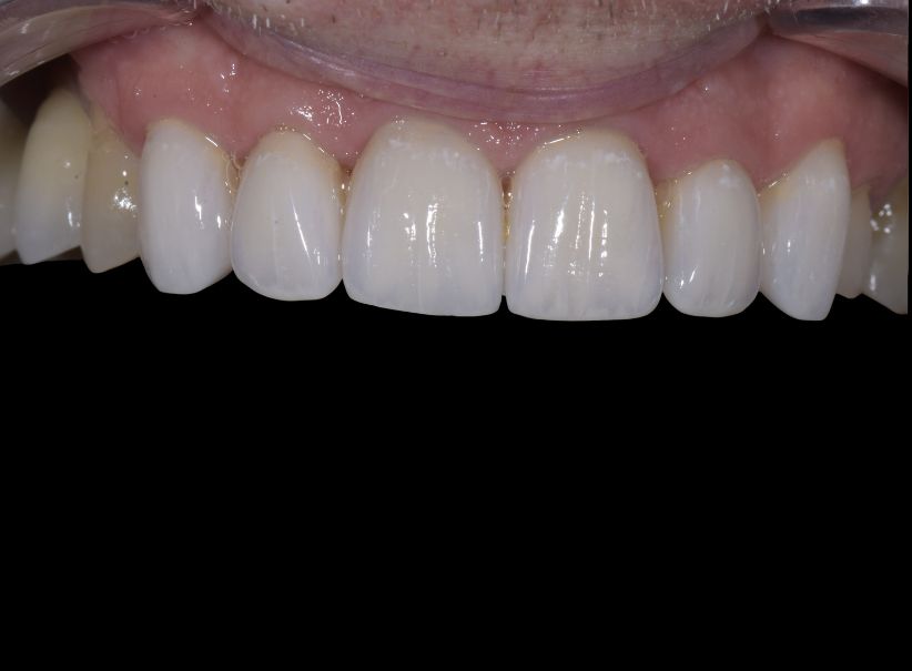veneer replacement smile rejuvenation after