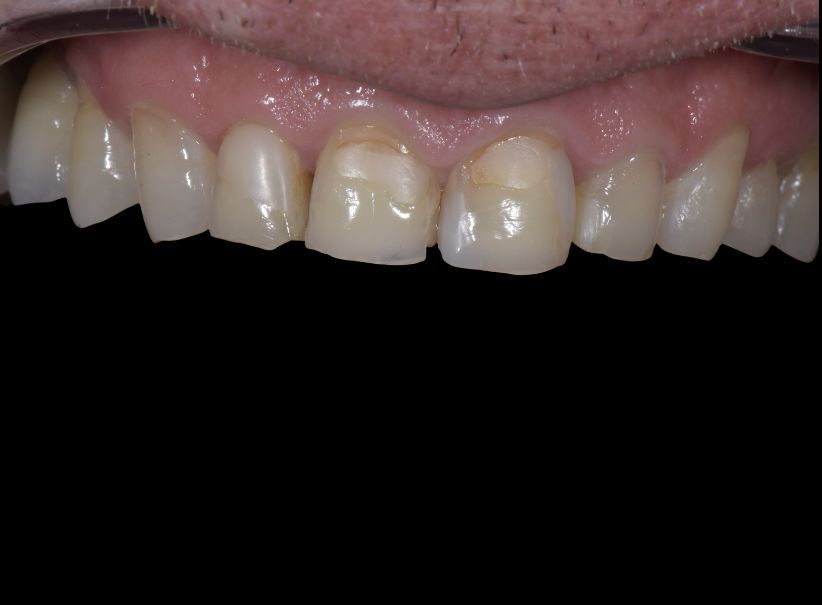 veneer replacement smile rejuvenation before veneer replacement smile rejuvenation before