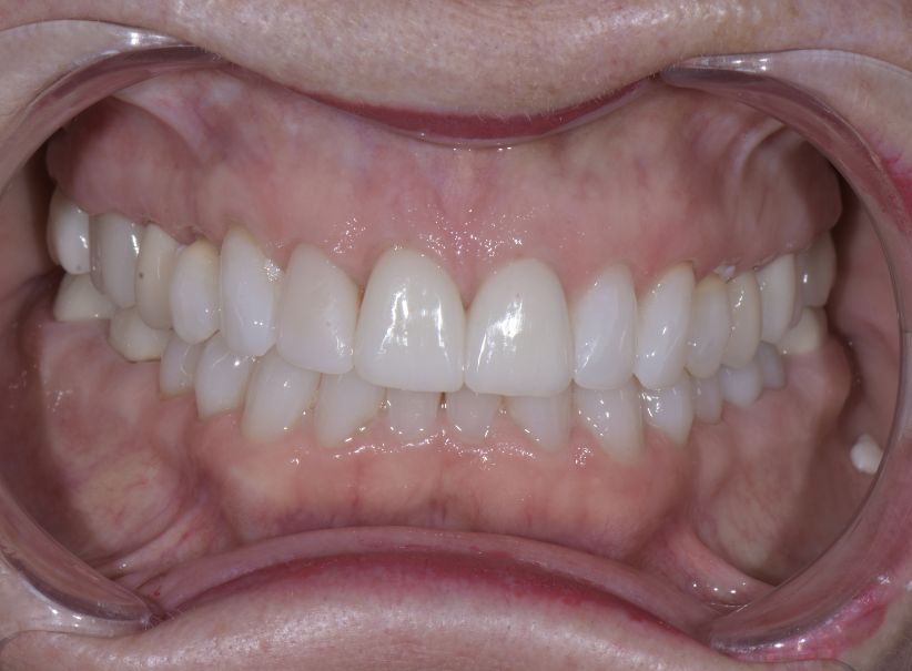 veneer restoration after crown loss after