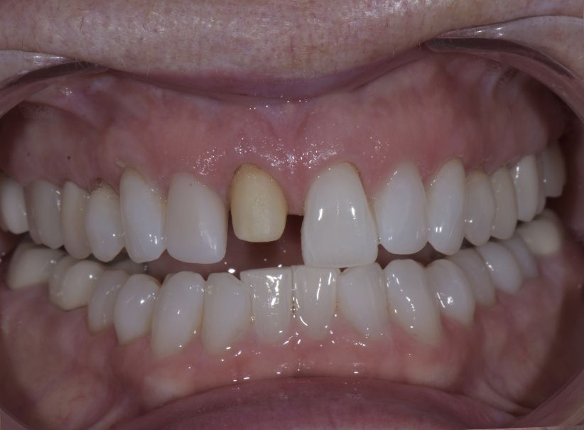 veneer restoration after crown loss before veneer restoration after crown loss before