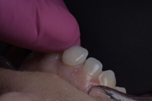 crown lengthening procedure dr dimple desai, aacd