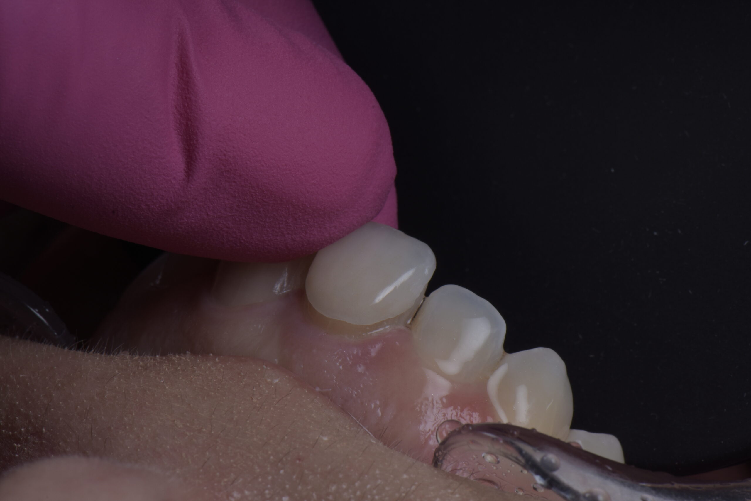 crown lengthening procedure dr dimple desai, aacd