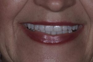 veneer cosmetic dentistry newport beach near me best dentist in newport OC dentists orange county after veneer treatment