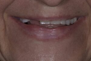 veneers newport beach cosmetic dentist veneers before treatment best cosmetic dentist near me | Cosmetic Dentistry just got easier and pain free at Luminous Smiles